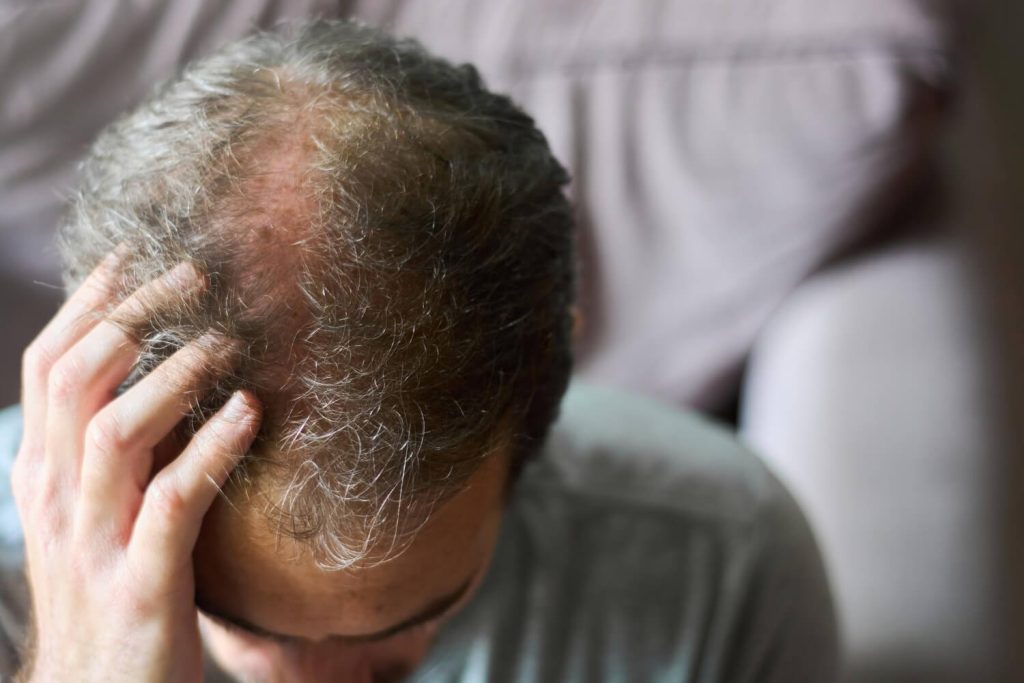 Hair Loss