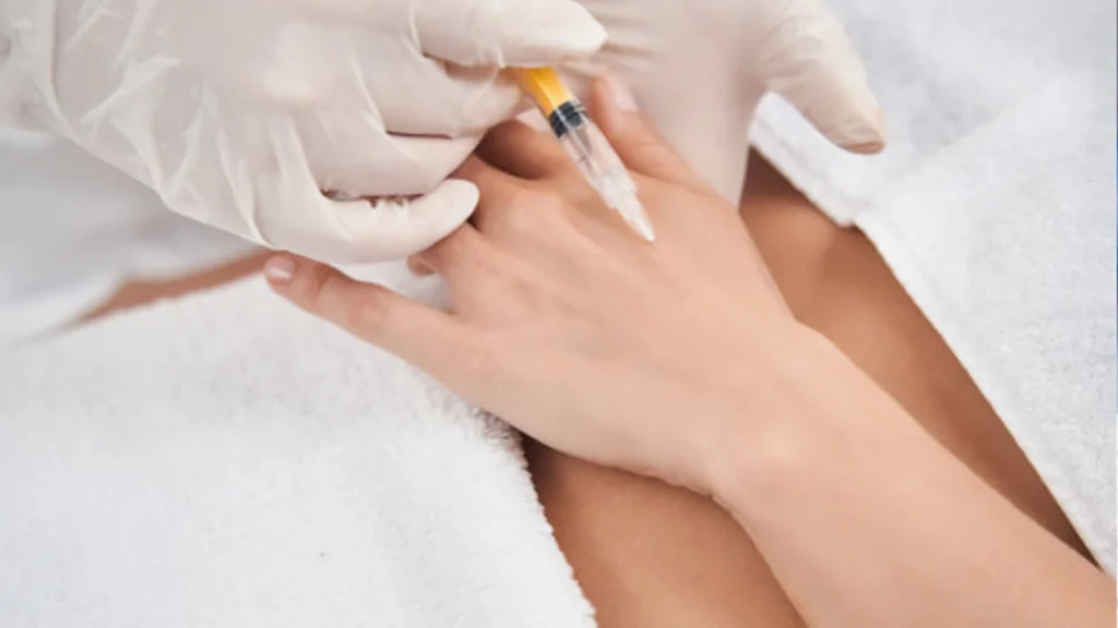 Calcium Fillers for Hand Rejuvenation