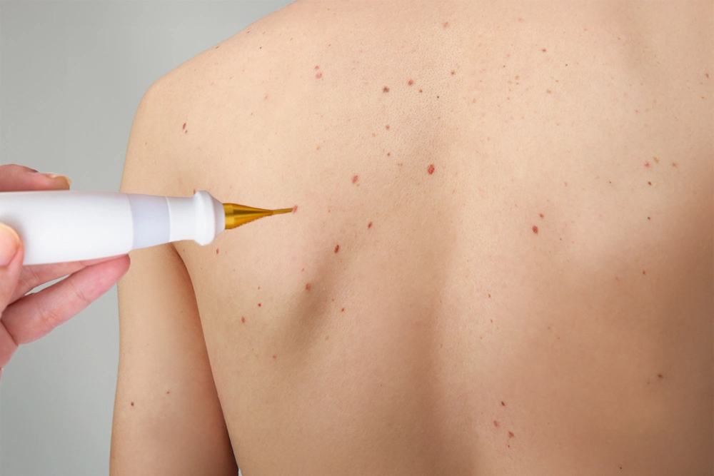 Jet Plasma for Moles