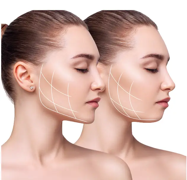 Double Chin Reduction
