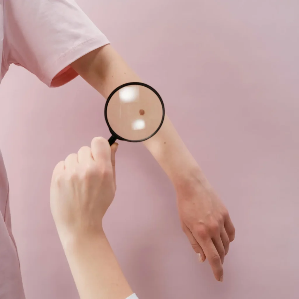 Mole Removal