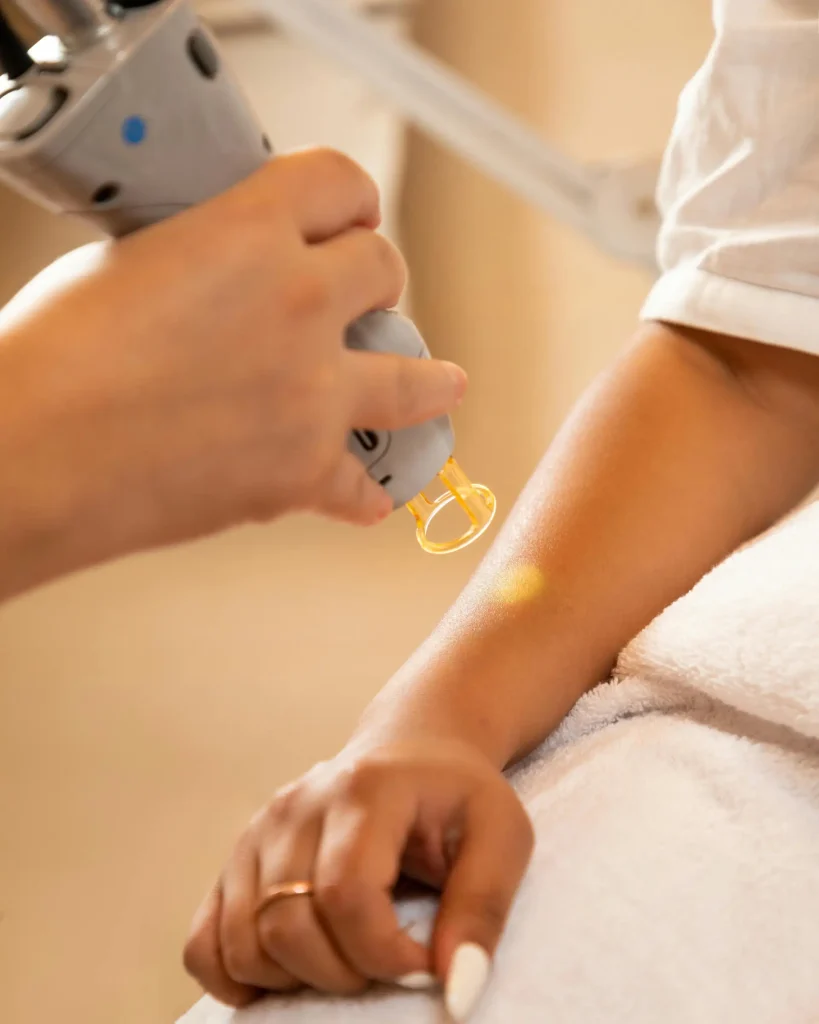 Laser Pigmentation Removal