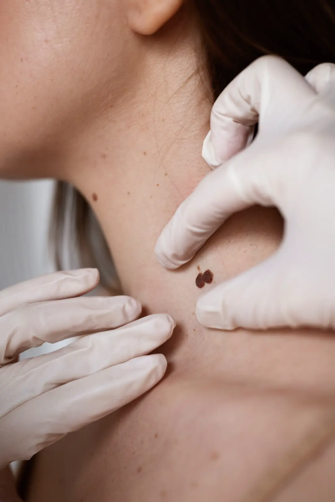 Skin Tag Removal