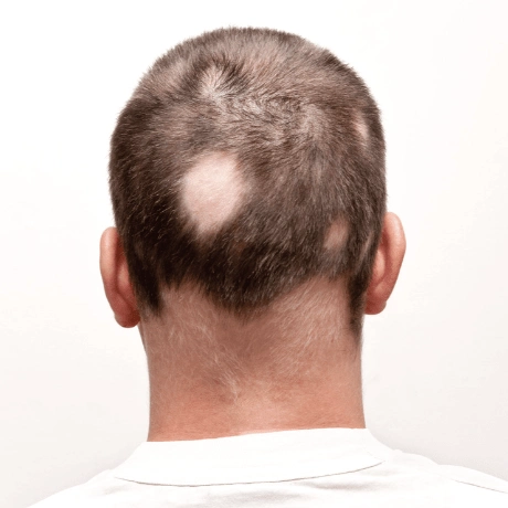 Alopecia